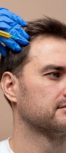 man-getting-prp-injection-alopecia-min